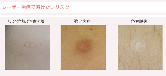レーザー治療で避けたいリスク