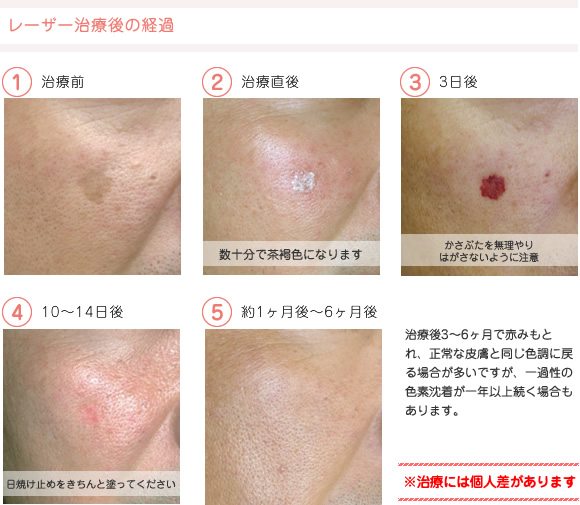 レーザー治療後の経過